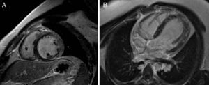 Cardiac magnetic resonance imaging with myocardial suppression after contrast. Late gadolinium enhancement reveals multiple areas of subepicardial myocardial fibrosis, mainly in the inferior and lateral walls, in short-axis (A) and 4-chamber views (B).