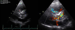 Ecocardiograma transtorácico: tubo de Dacron na aorta ascendente (losango azul); volumoso aneurisma (53×71mm) com trombo (losango vermelho) e fluxo com aparente origem na zona proximal e distal do tubo.