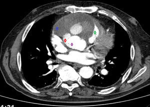Angio-TC torácica: visualiza-se saída de contraste (losango vermelho) por fuga proximal no tubo de Dacron (losango roxo), condicionando volumoso aneurisma da aorta ascendente com trombo organizado (losango azul), condicionando compressão do tronco da artéria pulmonar (losango verde).