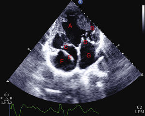 Echocardiogram in apical 4-chamber view showing double-inlet dominant left ventricle (A), separated from the accessory right ventricle (B) by a hypoplastic intraventricular septum. The atrioventricular connection is discordant: mitral (C) and tricuspid (D) valves. Pacemaker electrode (E), right atrium (F) and left atrium (G).
