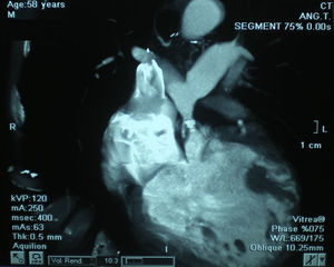 Computed tomography angiography showing pulmonary valve stenosis and hypoplastic right ventricular outflow tract.