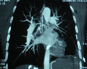 Computed tomography angiography showing systemic–pulmonary collateral circulation via bronchial artery branches.