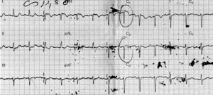 Imagem do ECG à entrada no serviço de urgência. Derivações V1 e V2 com supradesnivelamento de 2mm do segmento ST em rampa descendente e onda T negativa simétrica – padrão de Brugada tipo 1.