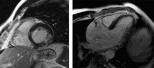 Realce tardio da parede lateral inferior basal, subendocárdico. Sequência PSIR. Incidências eixo-curto e três câmaras.
