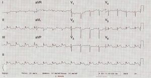12-lead electrocardiogram with ST-segment elevation in leads II, III, aVF, V5 and V6.