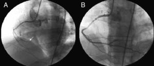 (A) Coronary angiography showing distal occlusion of the right coronary artery; (B) final result after thrombus aspiration and stent implantation.
