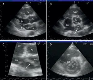(A) parasternal long-axis view; (B) parasternal short-axis view of the aortic valve; (C) zoom of short-axis view; (D) D-shaped left ventricle. Ao: aorta; IVS: interventricular septum; LA: left atrium; LV: left ventricle; RA: right atrium; RV: right ventricle; RVOT: right ventricular outflow tract; Tr: thrombus.