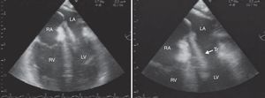 Transesophageal echocardiogram showing thrombus crossing the interatrial septum. LA: left atrium; LV: left ventricle; RA: right atrium; RV: right ventricle; Tr: thrombus.