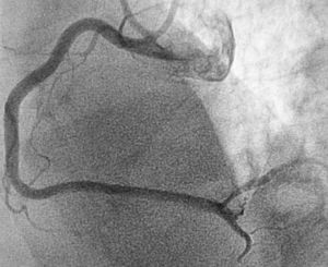 Artéria coronária direita após aspiração de trombos e angioplastia de balão.