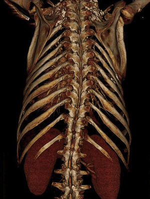 Reconstrução por tomografia computorizada multidetetores mostrando deformidade torácica, cifoescoliose e rins hiperplásicos (A).