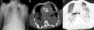 Radiografia do tórax infiltrado parenquimatoso bilateral e lesões nodulares dos tecidos moles em relação com lipodistrofia (A) e imagens da TC do tórax ao nível da prótese aórtica, janela mediastínica (B) e janela de pulmão (C), focos de consolidação parenquimatosa bilateral, densificação em «vidro despolido» e derrame pleural bilateral.
