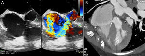 (A) Transesophageal echocardiography with and without color Doppler revealing subaortic flow to the right atrium; (B) cardiac computed tomography confirming the presence of a subaortic fistula (arrow).