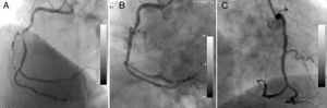A long, angulated, and eccentric critical lesion in the mid right coronary artery (A); type I coronary perforation limited to the vessel wall without extravasation (B); control angiogram showing no extravasation (C) after prolonged balloon inflation at the ruptured area.