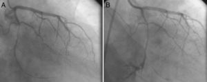 A thin, long, eccentric and calcified critical lesion in the mid circumflex coronary artery (A); guidewire-induced type III coronary rupture demonstrating significant contrast streaming into the pericardium (B).