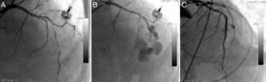 Long, thin, angulated and eccentric critical sequential lesions with thrombus in the mid to distal portion of the left anterior descending coronary artery (A); type IV coronary rupture showing prominent contrast flow into the left ventricle (B); control angiogram showing no extravasation around the target area after covered stent implantation (C).