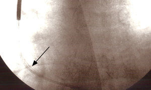 Radioscopia, incidência PA, com visualização de fio condutor para além da sombra do cateter (exteriorização) na porção situada aurícula direita (seta).