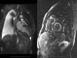 A patient with decompensated congestive heart failure as evidenced by massive pleural effusion (left) had very good LV systolic function with concentric hypertrophy, while the LGE sequence (right) was diagnostic for amyloidosis.