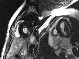 A patient initially thought to have amyloidosis is found to have no subendocardial LGE. The signal is also present in the cavity. This patient has mid-lateral wall involvement and was later diagnosed with Fabry's disease.