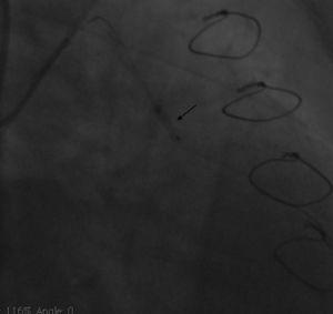 Angiogram showing stent deployment (arrow).