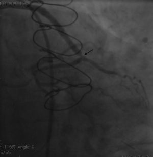 Angiogram showing significant stent recoil (arrow).