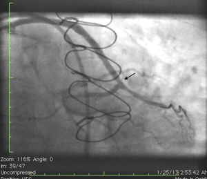 Angiogram showing expanded stent after cutting balloon angioplasty (arrow).