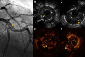 (A) Coronary angiography of the left anterior descending artery (LAD) in right anterior oblique cranial view, showing an extensive intraluminal filling defect, multilobed, compatible with stent thrombosis (arrow). (B and C) Intravascular ultrasound (IVUS) images showing extensive stent strut malapposition (arrow), which appears to be coated with echogenic tissue that could correspond to adherent thrombus. (C) Extensive stent thrombosis (asterisk) and aneurysmal dilatation of the vessel outside the struts (arrow). (D and E) Optical coherence tomography (OCT) images at the same level as the previous IVUS, showing strut malapposition (arrow) with adherent platelet thrombus. (E) Extensive stent thrombosis (asterisk).