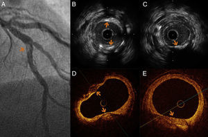 (A) Coronary angiography of the LAD in right anterior oblique cranial view, showing a focal lesion, spiculated, with irregular edges, consistent with highly calcified atheroma (arrow). (B and C) IVUS images of the calcified lesion in the LAD. (B) Two calcified lesions characterized by significant birefringence, with acoustic back-scattering (arrows). (D and E) OCT shows a lesion with clear borders and regions of late enhancement and low signal, identifying a large calcified lesion (arrows).
