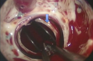Imagem intraoperatória: pannus em prótese aórtica (seta).