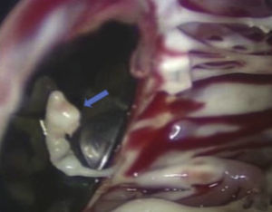 Imagem intraoperatória: corda rota (seta) do aparelho subvalvular mitral que impedia, de forma intermitente, o encerramento da prótese.