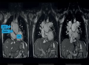 The compressed baffle is better seen in this image where the pulmonary artery trunk is aneurysmatic. The image on the extreme right shows the inferior vena cava also returning to the subpulmonary left ventricle. LV: left ventricle; SVC: superior vena cava.