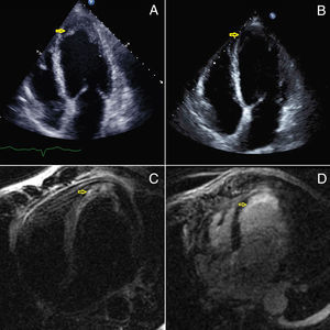 A) 2D echocardiogram showing slight increased of the apical wall thickness (arrow). B) 2D echocardiogram after treatment showing a decreased in the apical wall thickness (arrow). Cardiac MRI showing an elevated T2 signal intensity in the septo apical and apical segments corresponding to tissue edema (C) with delayed subendocardial enhancement in the same segments (D).