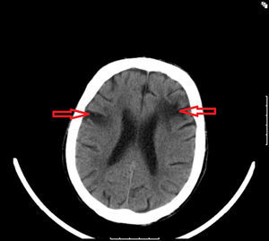 Brain cardiac tomography: ischemic lesions with non-recent multiple sequelae (red arrows).