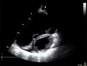 Transthoracic echocardiography: severe dilatation of the right chambers. Flattening of the ventricular septum during diastole suggests volume overload.
