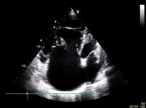 Transthoracic echocardiography: abnormal tricuspid valve with dysplastic and asymmetric leaflets and high implantation of the septal leaflet (>8mm/m2 downstream of the atrioventricular junction).