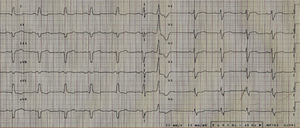 Electrocardiogram: sinus rhythm, intraventricular conduction delay (QRS duration 143 ms) and no obvious left bundle branch block.