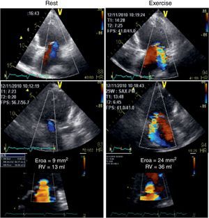 Color flow Doppler echocardiogram and flow convergence proximal to the effective regurgitant orifice at rest (left) and at peak exercise (right). The left panel demonstrates mild functional mitral regurgitation while the right panel shows the increase in mitral regurgitation following exercise, becoming moderate.