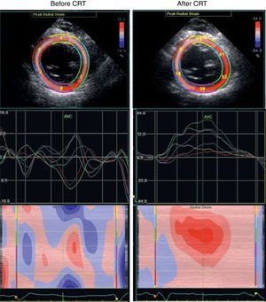 Speckle tracking radial strain analysis (left) before and (right) after cardiac resynchronization therapy (CRT): a significant decrease in LV dyssynchrony is seen after CRT.