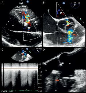 (A) Transthoracic color Doppler echocardiography, parasternal long axis view, showing a continuous flow from the aorta to the right ventricle (arrow). (B) Transesophageal color Doppler echocardiography, mid-esophageal plane at 51°, showing the jet of the fistula (arrow) and moderate eccentric aortic regurgitation. (C) Continuous wave Doppler showing systolic-diastolic flow at the fistula level (arrow). (D) Transesophageal echocardiography, mid-esophageal plane at 124° (zoomed in on the aorta), showing a tubular communication between the right sinus of Valsalva and the right ventricle (arrow). Ao: aorta; LA: left atrium; LV: left ventricle; RA: right atrium; RV: right ventricle.