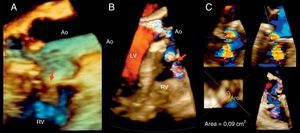(A) Three-dimensional transesophageal echocardiography showing a tubular communication between the right sinus of Valsalva (enlarged) and the right ventricle. (B) Three-dimensional color flow showing the fistula (arrow) and the aortic regurgitation eccentric jet directed toward the anterior mitral leaflet. (C) Multiplanar reconstruction, three-dimensional color flow, showing a vena contracta area calculated by direct planimetry of 0.09 cm2. Ao: aorta; LV: left ventricle; RV: right ventricle.