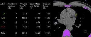 Score de cálcio – distribuição pelas artérias coronárias epicárdicas. Cx: circunflexa; LAD: descendente anterior; LM: tronco comum; RCA: coronária direita.
