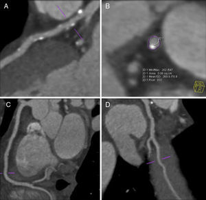 AngioTC cardíaca: A – placas predominantemente calcificadas dispersas no segmento proximal da artéria descendente anterior, sem condicionar estenose significativa; B – placa mista, excêntrica, com remodelagem positiva; C e D – artérias circunflexa e coronária direita (vaso dominante) com placas mistas minor, sem estenoses significativas.