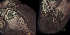 Imagens de reconstrução volumétrica da árvore coronária demonstrando placas ateroscleróticas dispersas na coronária esquerda, não condicionando estenoses significativas.