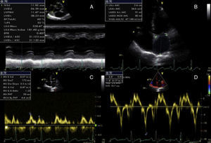 Ecocardiograma transtorácico revelando hipertrofia ventricular esquerda excêntrica (A), dilatação auricular esquerda (B), fluxo Doppler transmitral e padrão de enchimento normais (C e D).