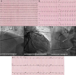 Fibrilhação ventricular (A) responsável pela paragem cardíaca extrahospitalar. Electrocardiograma realizado após as manobras de reanimação cardiopulmonar avançada (B). Angiografias que mostram a oclusão trombótica aguda da artéria coronária direita (C), uma coronária esquerda com circunflexa dominante (D) e o resultado final da angioplastia primária à coronária direita não dominante (E) com recuperação do fluxo em dois ramos agudos marginais dirigidos ao ventrículo direito (setas). O electrocardiograma com elevação do segmento ST em derivações V2R-V4R (F) confirma a existência de uma lesão isquémica do ventrículo direito.