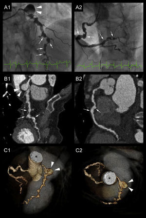 Abnormal coronary artery appearance in different techniques. A large aneurysm (arrowheads) is seen at the distal edge of the left main trunk (A1, B1, C1 and C2). The left anterior descending artery (LAD) presents several aneurysms (arrows) but also severe stenotic lesions (resembling a string of beads) with a poor distal bed (A1, B1 and C1). Note the absence of circumflex artery visualization. The ectatic right coronary artery (RCA) also presenting aneurysmal formations (arrows) and obstructive lesions (A2, B2 and C2). A: coronary angiograms of the LAD and RCA. B: curved planar reformation (CPR) in multislice computed tomography (MSCT) of the LAD and RCA. C: Three-dimensional MSCT reconstructions (volume-rendering technique). *: ascending aorta.
