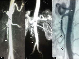 (A) A computed tomography (CT) scan within the first 24hours showed absence of contrast in the superior mesenteric artery (SMA) (arrow). Follow-up CT scans demonstrated gradual improvement in flow through the SMA (arrows) at 10 days (B) and two months (C). Ao: aorta; SMA: superior mesenteric artery.