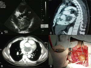 (A) A solid mass in the left atrium seen with transesophageal echocardiography, measuring 6.65 cm×4.22 cm (T). Axial (B) and sagittal (C) CT scans of the thorax showing a large filling defect in the left atrium (T). (D) Photograph of the resected mass (6.5 cm×4.5 cm). LA: left atrium; LV: left ventricle; MV: mitral valve; T: tumor.