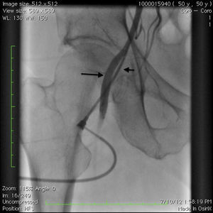 Angiogram showing the sheath in the common femoral artery showing the profunda femoris (large arrow). The SFA is occluded at the origin (small arrow).