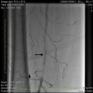 Angiography through the common femoral artery sheath showing the collateral to the SFA (short arrow) and retrograde filling of the distal and mid SFA (long arrow) after wiring the SFA occlusion via a retrograde popliteal approach.