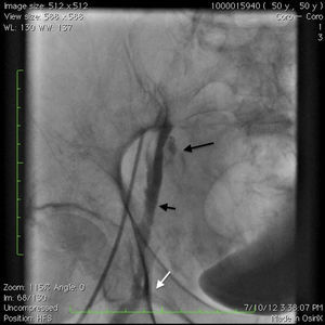 Angiogram showing retrograde filling of the proximal superficial femoral artery (SFA), collateral to the SFA (white arrow) and dissection plane in the external iliac artery (short arrow) with perforation into the retroperitoneal space (long arrow).
